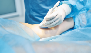 Treating Pain Sourced From the Spine with Radiofrequency Ablation - APSM